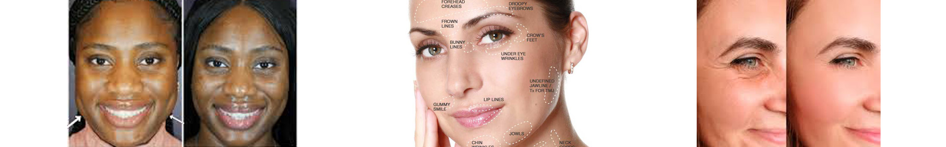 botox_mesa.jpg